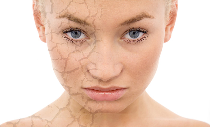 Chemical Facial Peels in and in Estero Florida