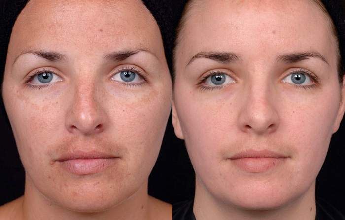 Lactic Lightening Facial Peel  in and near Naples Florida