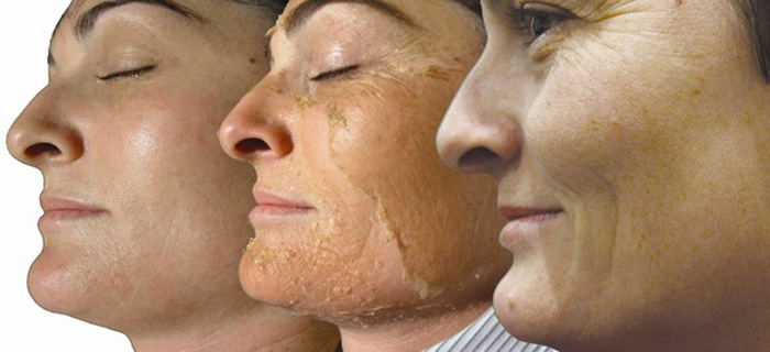 TCA Depigmentation Facial Peel in and in Estero Florida