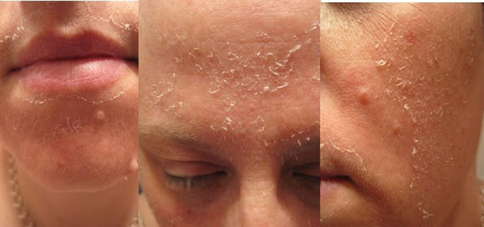 Glycolic Peel in and near Ft Myers Florida