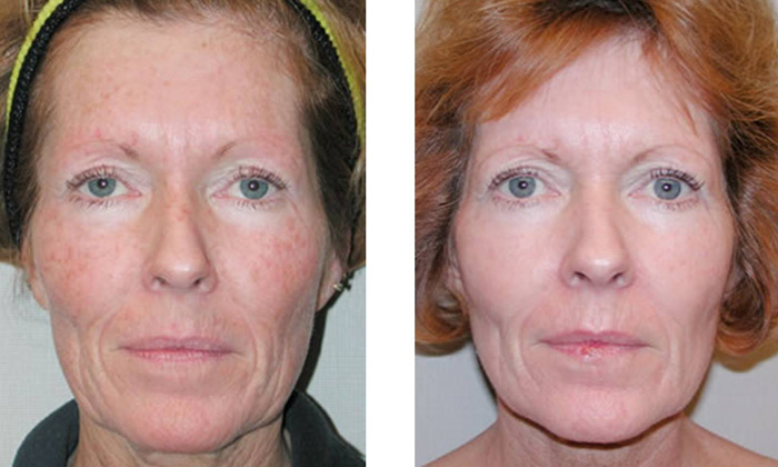 Lactic Lightening Facial Peel  in and near Ft Myers Florida