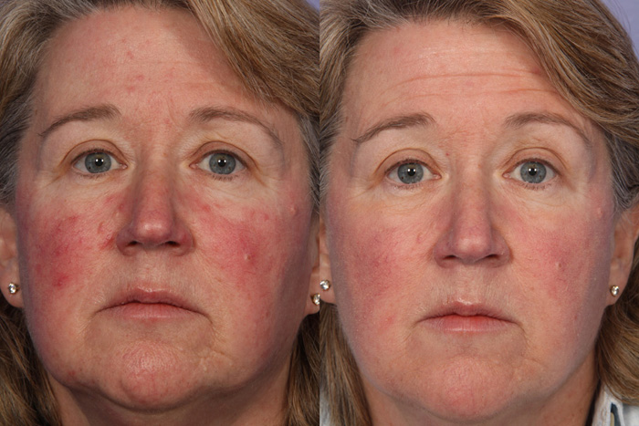 Cranberry Turnover Facial Peel in and near Naples Florida