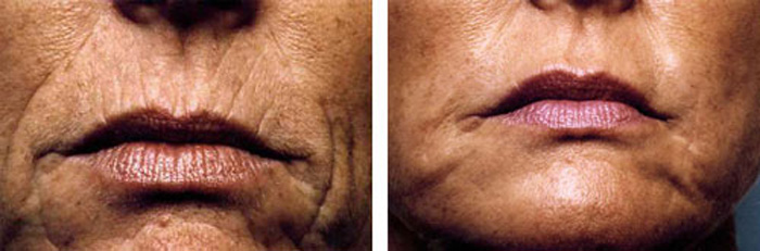 TCA Depigmentation Facial Peel in and near Naples Florida