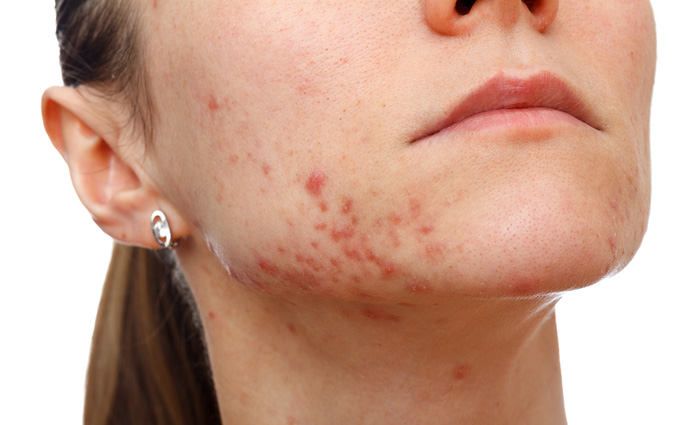 Acne Facials in and near South Fort Myers Florida
